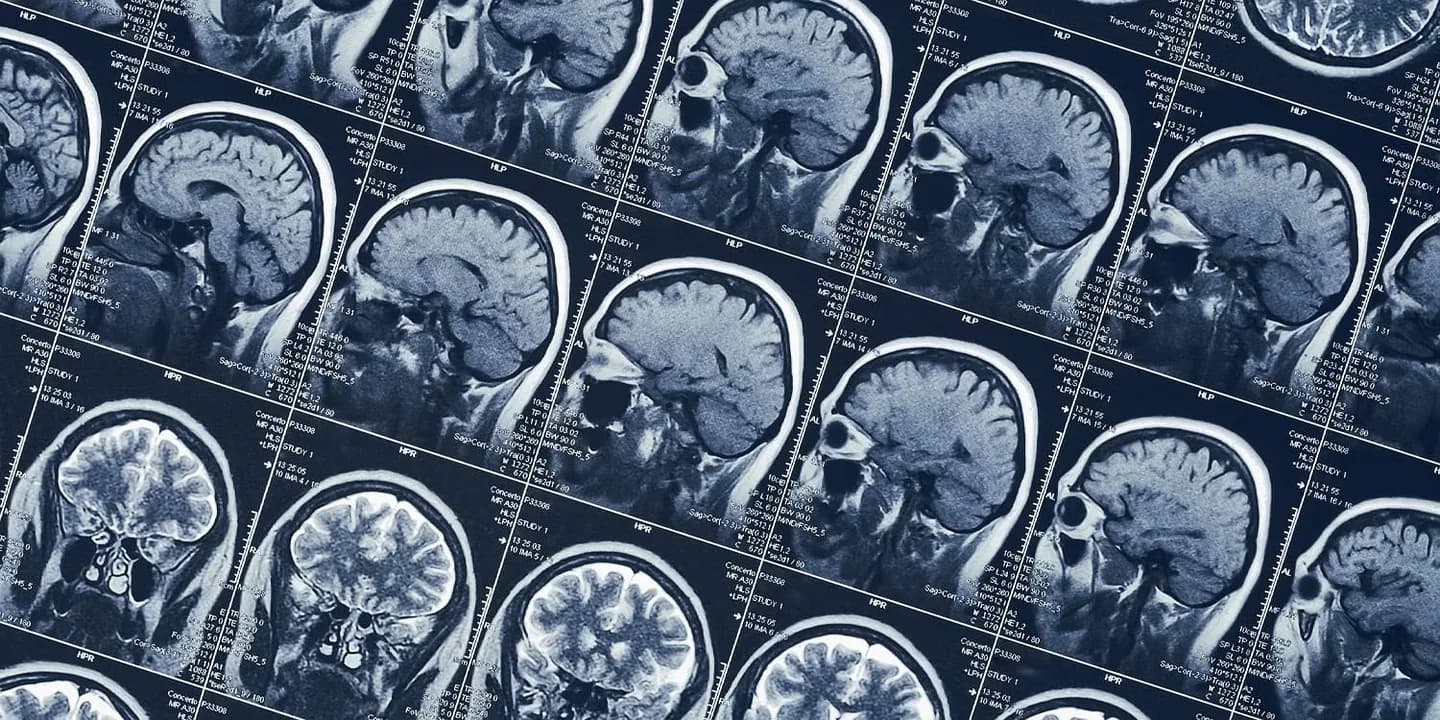 Четыре пути к болезни Альцгеймера: изучение медицинских траекторий