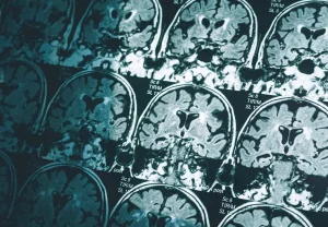 Мужской мозг стареет быстрее: исследование опровергает причину женского Альцгеймера