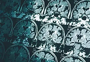 Мужской мозг стареет быстрее: исследование опровергает причину женского Альцгеймера