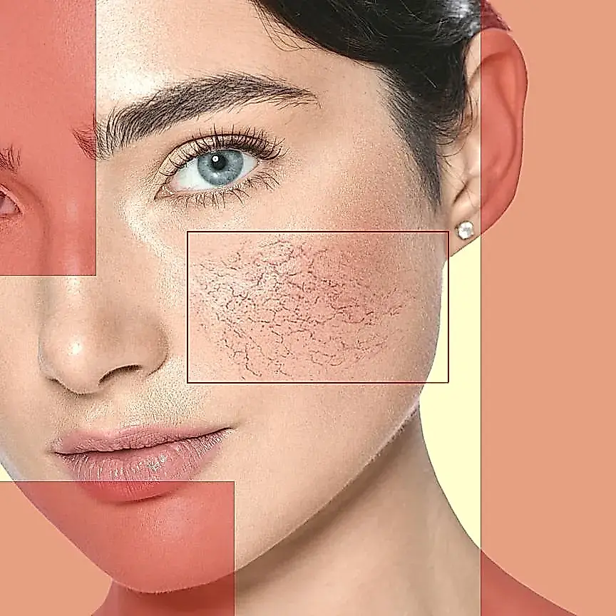 Pulsed Dye Lasers: секрет дерматологов против покраснений