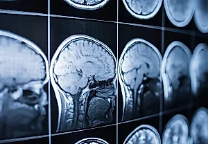 Связь между сверхпереработанной едой и деменцией у пожилых