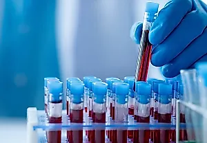 Новые анализы крови выявляют болезнь Альцгеймера у взрослых с синдромом Дауна