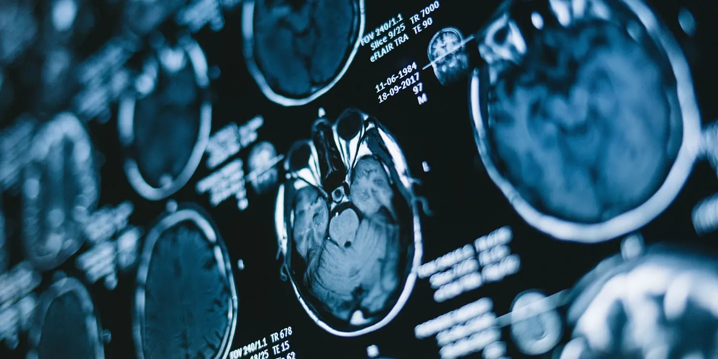 Мозг при СДВГ: почему застреваем в настоящем