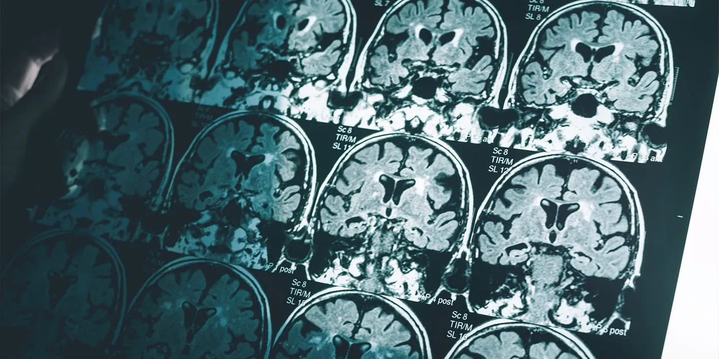 Мужской мозг стареет быстрее: исследование опровергает причину женского Альцгеймера